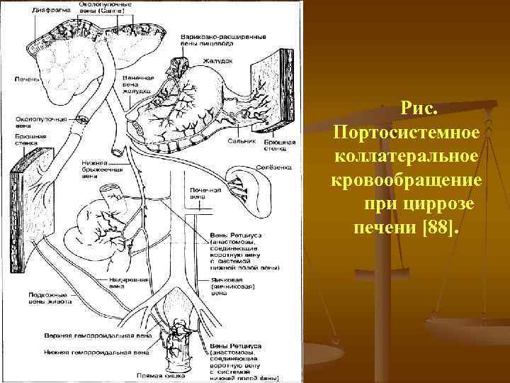 Рис. Портосистемное коллатеральное кровообращение при циррозе печени [88]. 