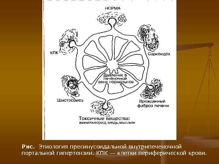 Рис. Этиология пресинусоидальной внутрипеченочной портальной гипертензии. КПК — клетки периферической крови. 