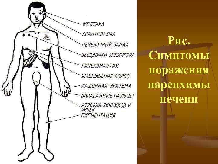 Рис. Симптомы поражения паренхимы печени 