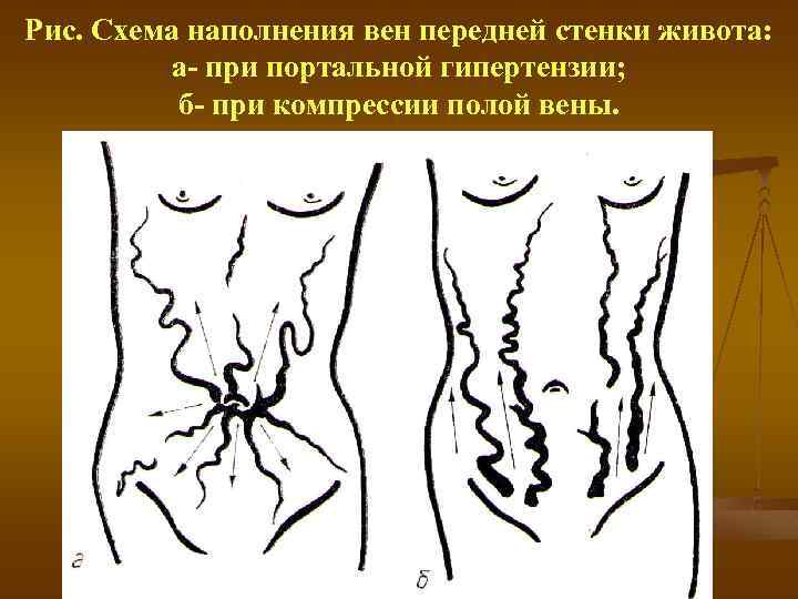 Рис. Схема наполнения вен передней стенки живота: а при портальной гипертензии; б при компрессии
