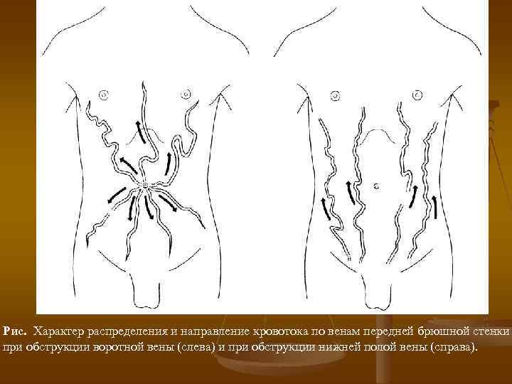 Рис. Характер распределения и направление кровотока по венам передней брюшной стенки при обструкции воротной