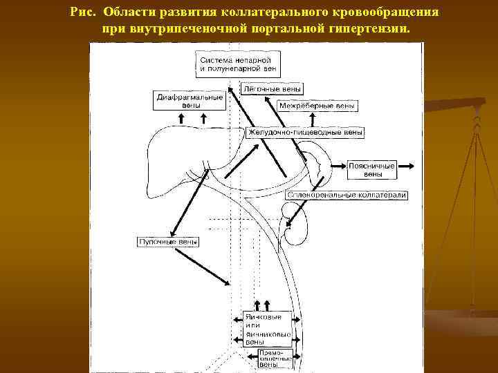 Рис. Области развития коллатерального кровообращения при внутрипеченочной портальной гипертензии. 