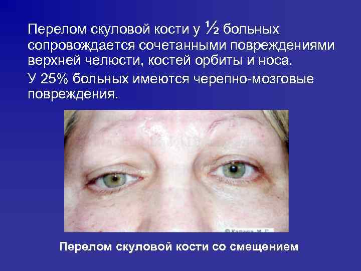 Перелом скуловой кости у ½ больных сопровождается сочетанными повреждениями верхней челюсти, костей орбиты и