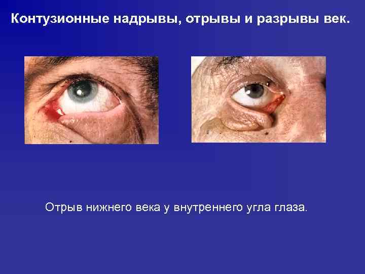 Контузионные надрывы, отрывы и разрывы век. Отрыв нижнего века у внутреннего угла глаза. 