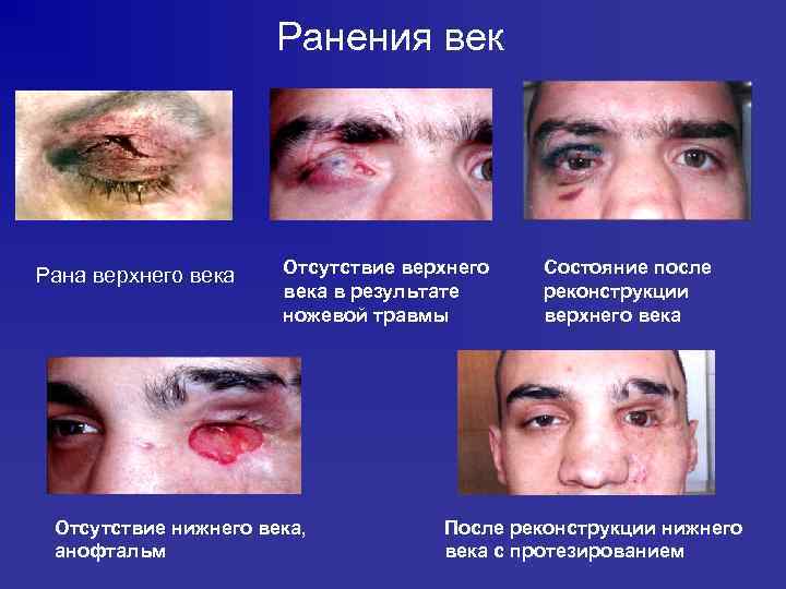 Ранения век Рана верхнего века Отсутствие верхнего века в результате ножевой травмы Отсутствие нижнего
