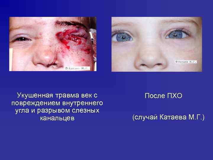 Укушенная травма век с повреждением внутреннего угла и разрывом слезных канальцев После ПХО (случай