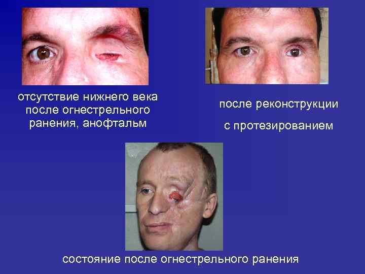 отсутствие нижнего века после огнестрельного ранения, анофтальм после реконструкции с протезированием состояние после огнестрельного