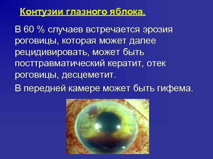Контузии глазного яблока. В 60 % случаев встречается эрозия роговицы, которая может далее рецидивировать,