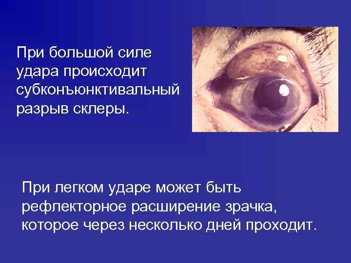 При большой силе удара происходит субконъюнктивальный разрыв склеры. При легком ударе может быть рефлекторное