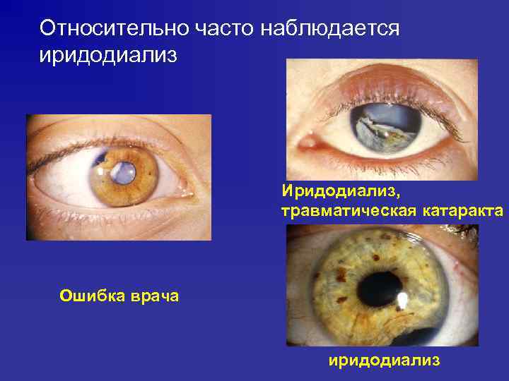 Относительно часто наблюдается иридодиализ Иридодиализ, травматическая катаракта Ошибка врача иридодиализ 