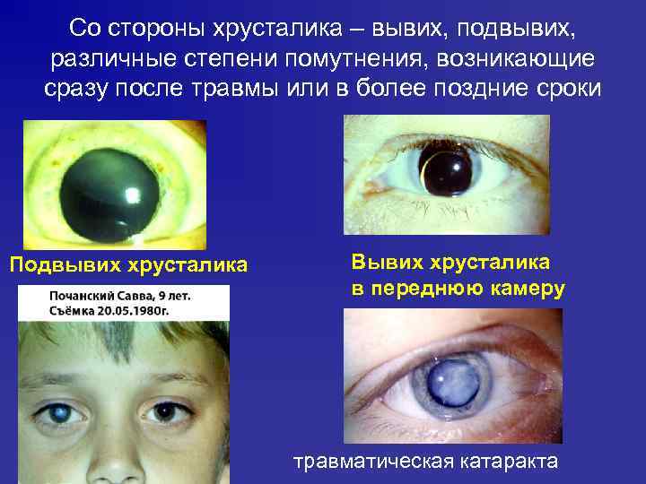 Со стороны хрусталика – вывих, подвывих, различные степени помутнения, возникающие сразу после травмы или