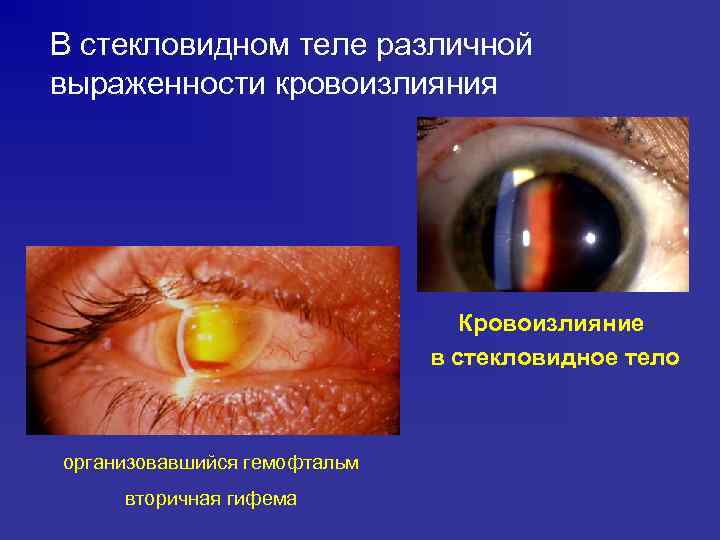 В стекловидном теле различной выраженности кровоизлияния Кровоизлияние в стекловидное тело организовавшийся гемофтальм вторичная гифема