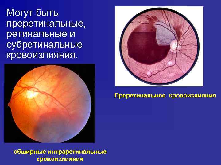 Могут быть преретинальные, ретинальные и субретинальные кровоизлияния. Преретинальное кровоизлияния обширные интраретинальные кровоизлияния 