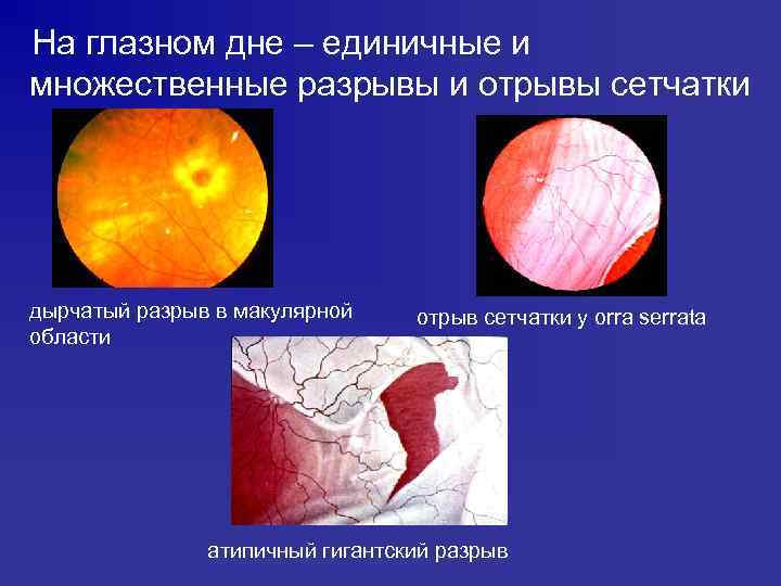 На глазном дне – единичные и множественные разрывы и отрывы сетчатки дырчатый разрыв в