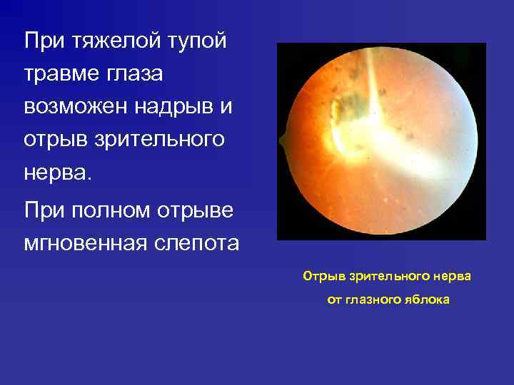 При тяжелой тупой травме глаза возможен надрыв и отрыв зрительного нерва. При полном отрыве