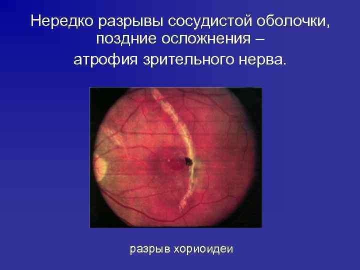 Нередко разрывы сосудистой оболочки, поздние осложнения – атрофия зрительного нерва. разрыв хориоидеи 