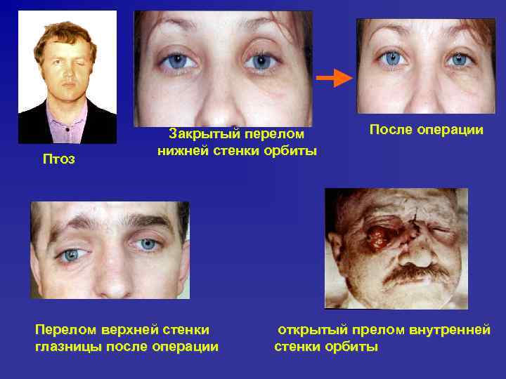 Птоз Закрытый перелом нижней стенки орбиты Перелом верхней стенки глазницы после операции После операции
