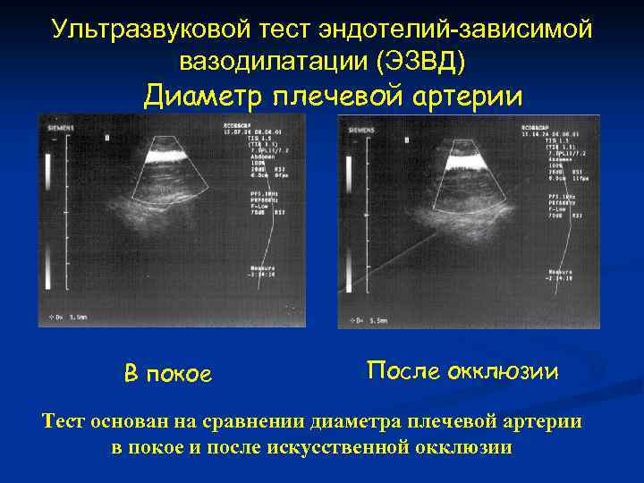 Ультразвуковой тест эндотелий-зависимой вазодилатации (ЭЗВД) Диаметр плечевой артерии В покое После окклюзии Тест основан