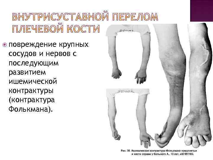  повреждение крупных сосудов и нервов с последующим развитием ишемической контрактуры (контрактура Фолькмана). 