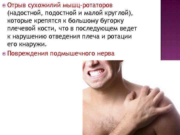  Отрыв сухожилий мышц-ротаторов (надостной, подостной и малой круглой), которые крепятся к большому бугорку