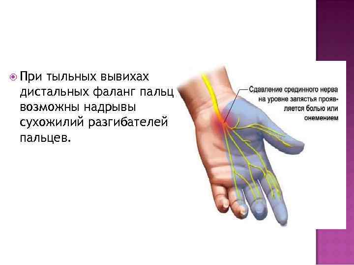  При тыльных вывихах дистальных фаланг пальцев возможны надрывы сухожилий разгибателей пальцев. 
