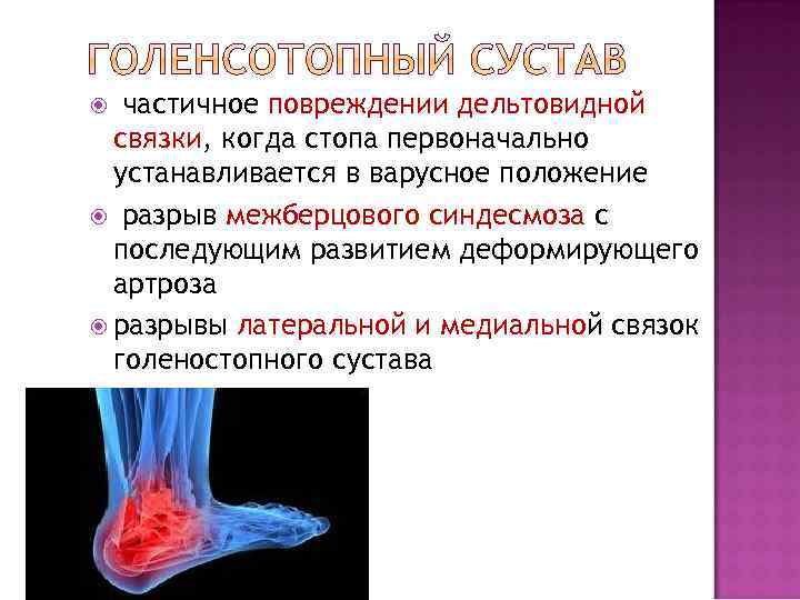  частичное повреждении дельтовидной связки, когда стопа первоначально устанавливается в варусное положение разрыв межберцового