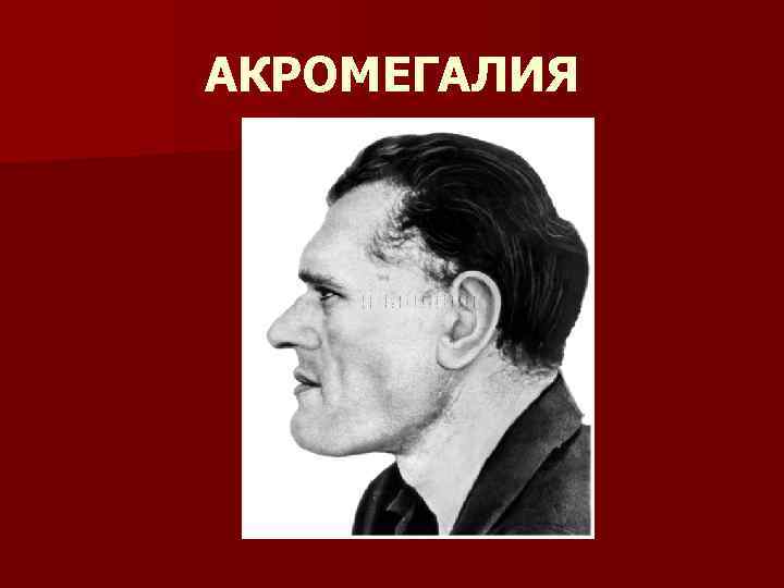 АКРОМЕГАЛИЯ 
