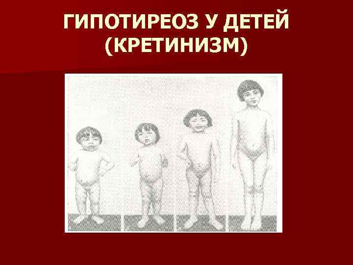 ГИПОТИРЕОЗ У ДЕТЕЙ (КРЕТИНИЗМ) 