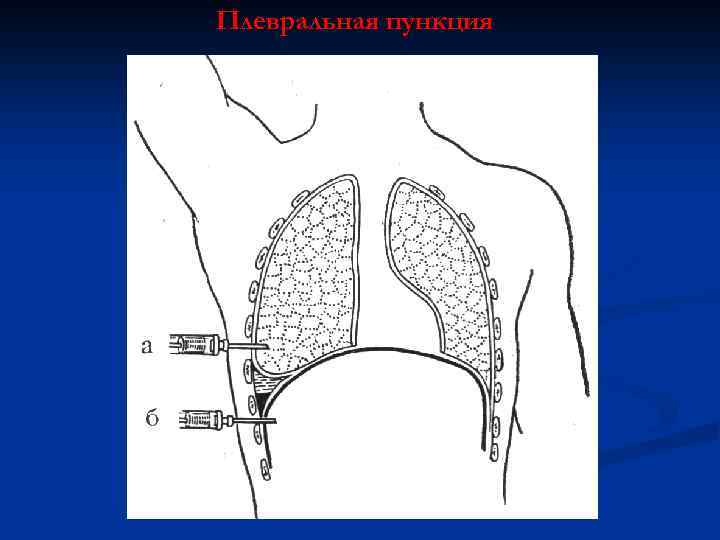 Плевральная пункция 