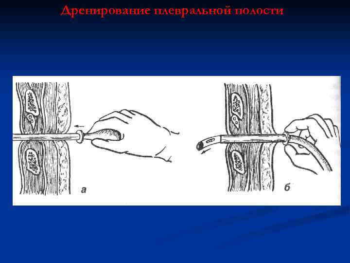 Дренирование плевральной полости 