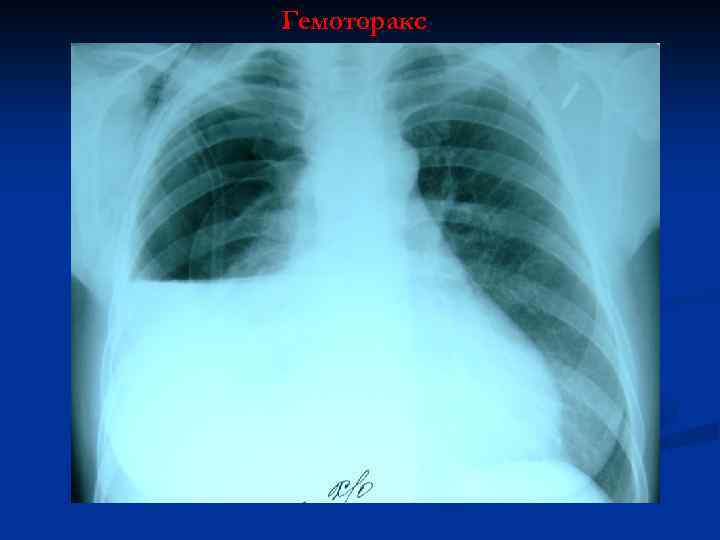 Лучевые признаки гидроторакса гемоторакса рентгеновская картина