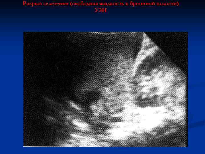Разрыв селезенки (свободная жидкость в брюшной полости) УЗИ 