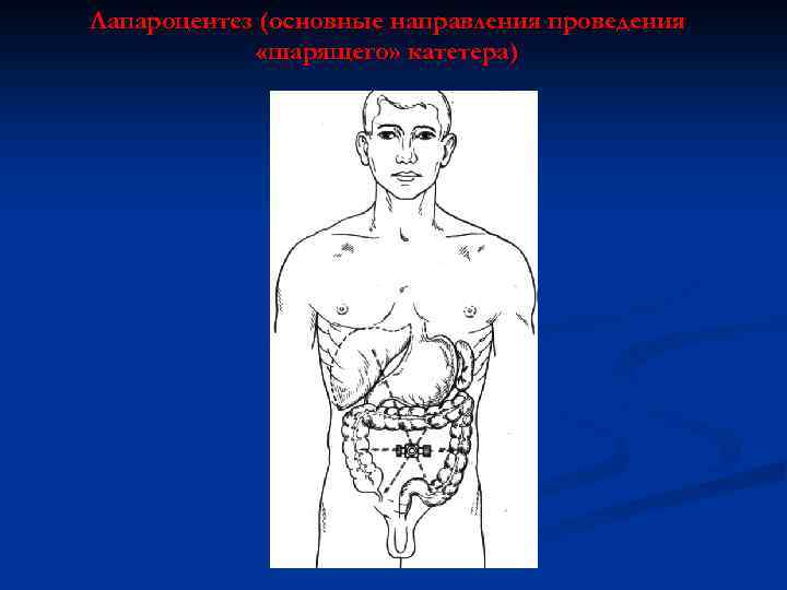 Лапароцентез (основные направления проведения «шарящего» катетера) 