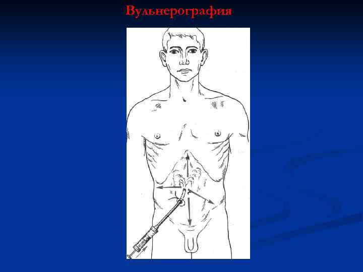 Вульнерография 