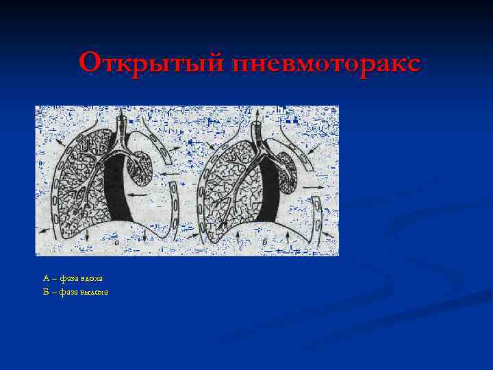 Открытый пневмоторакс А – фаза вдоха Б – фаза выдоха 