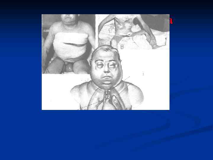 Подкожная эмфизема 