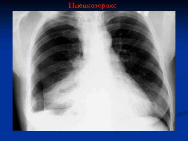 Пневмоторакс 