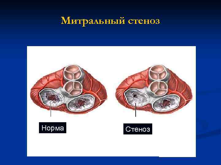  Митральный стеноз Норма Стеноз 