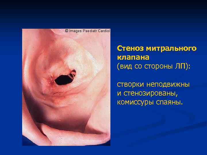 Стеноз митрального клапана (вид со стороны ЛП): створки неподвижны и стенозированы, комиссуры спаяны. 