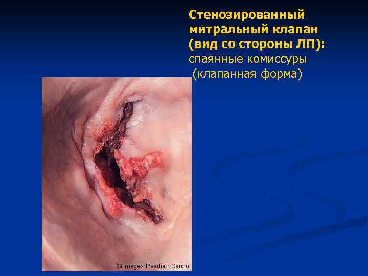 Стенозированный митральный клапан (вид со стороны ЛП): спаянные комиссуры (клапанная форма) 