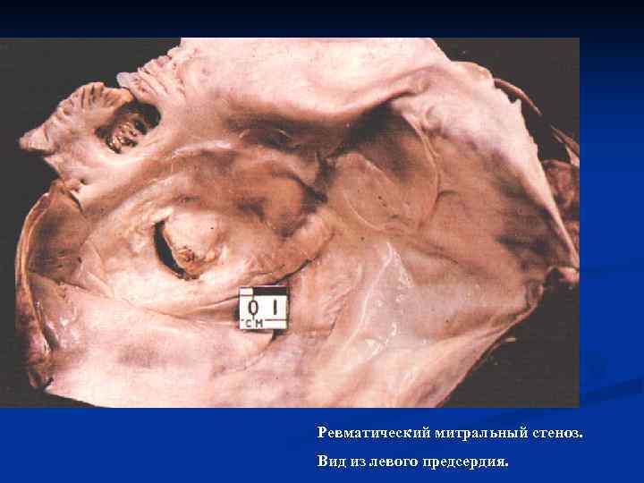 Ревматический митральный стеноз. Вид из левого предсердия. 