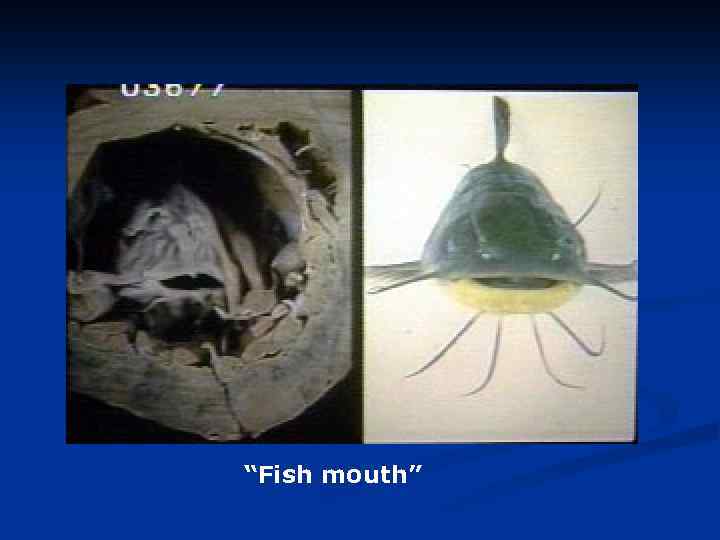 “Fish mouth” 