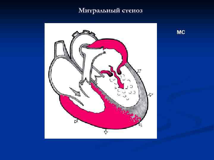 Митральный стеноз МС 