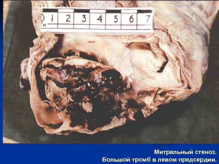  Митральный стеноз. Большой тромб в левом предсердии. 