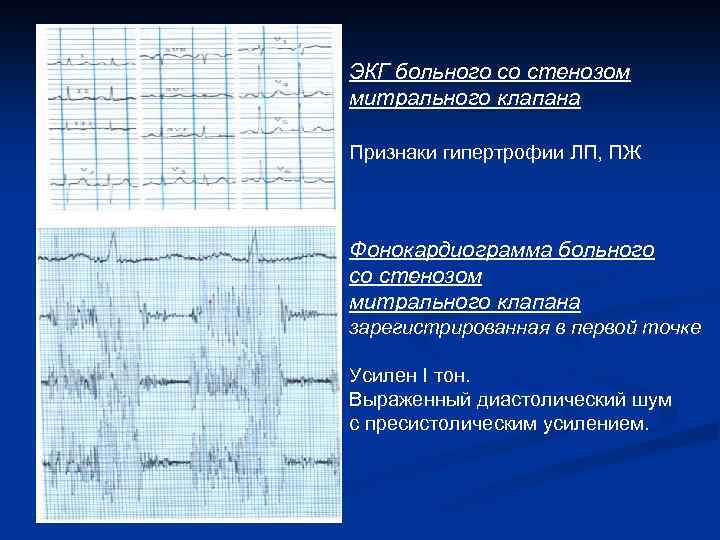 ЭКГ больного со стенозом митрального клапана Признаки гипертрофии ЛП, ПЖ Фонокардиограмма больного со стенозом