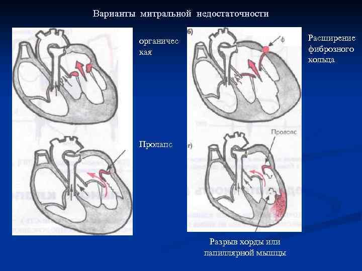 Варианты митральной недостаточности органичес Расширение кая фиброзного кольца Пролапс Разрыв хорды или папиллярной мышцы