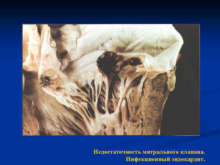 Недостаточность митрального клапана. Инфекционный эндокардит. 