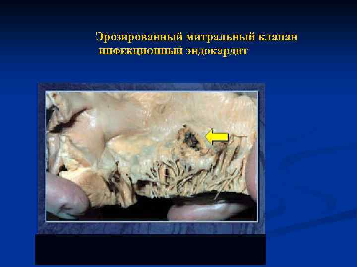 Эрозированный митральный клапан ИНФЕКЦИОННЫЙ эндокардит 