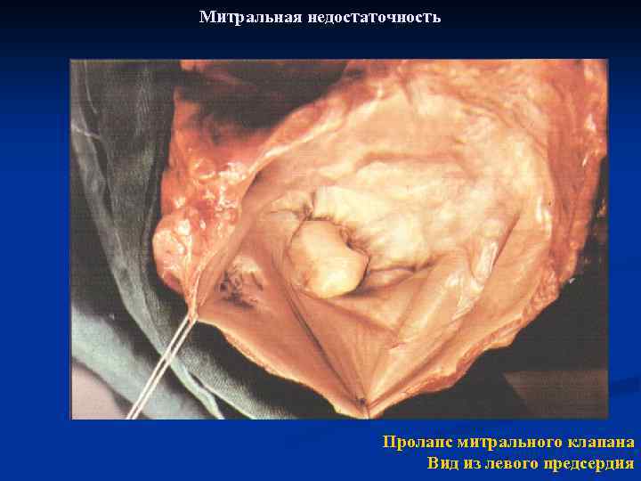 Митральная недостаточность Пролапс митрального клапана Вид из левого предсердия 