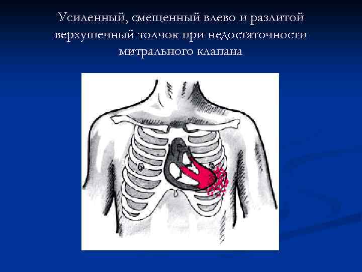 Усиленный, смещенный влево и разлитой верхушечный толчок при недостаточности митрального клапана 